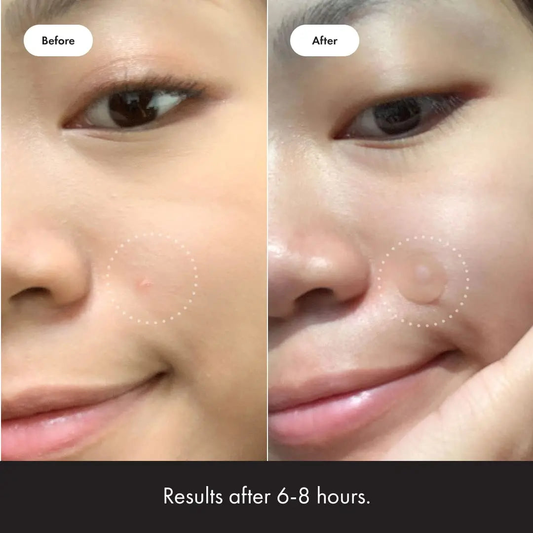 Mighty Patch™ Original patch from Hero Cosmetics - Hydrocolloid Acne Pimple Patch for Covering Zits and Blemishes in Face